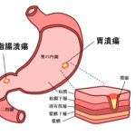胃潰瘍スピリチュアルな意味と性格