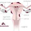子宮内膜症スピリチュアルな意味と性格