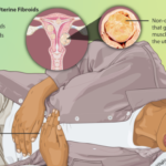 子宮筋腫スピリチュアルな意味と性格｜類線維腫スピリチュアル