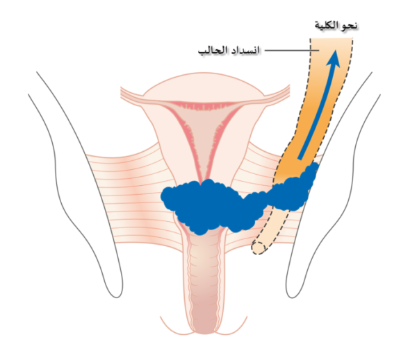 子宮頸がんスピリチュアルな意味と性格