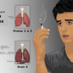 肺がんスピリチュアルな意味と性格